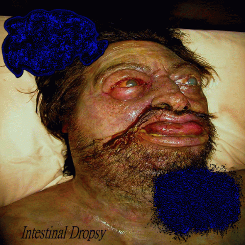 Lymphangiomas : Intestinal Dropsy